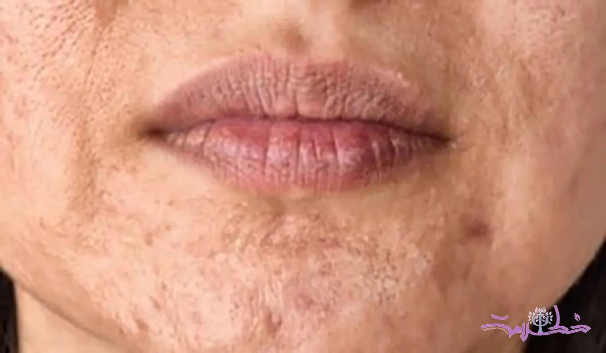 چه کنید در هوای گرما جوش نزنید ؟ + 16 روش 