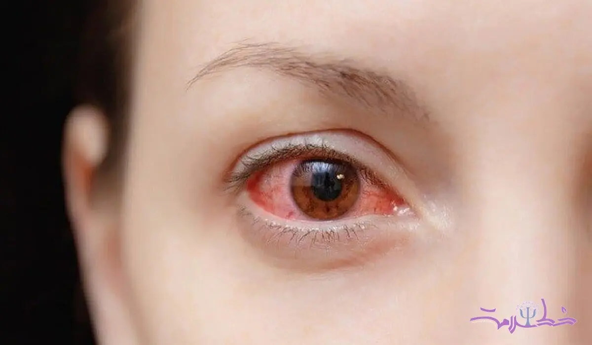 علل ایجاد التهاب قرنیه