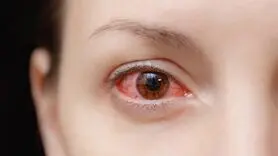 علل ایجاد التهاب قرنیه