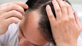 این نوع خاص از ریزش مو را جدی بگیرید / درمان سخت می شود