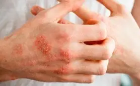 باور نمی کنید درمان های طبیعی اگزما اینقدر ساده باشد