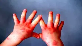 چه تفاوتی بین اگزما و پسوریازیس وجود دارد؟