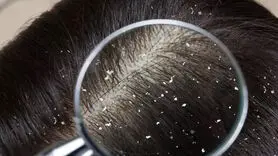 علت شوره سر از چه زمانی و چگونه سراغ تان می آید؟ + فیلم