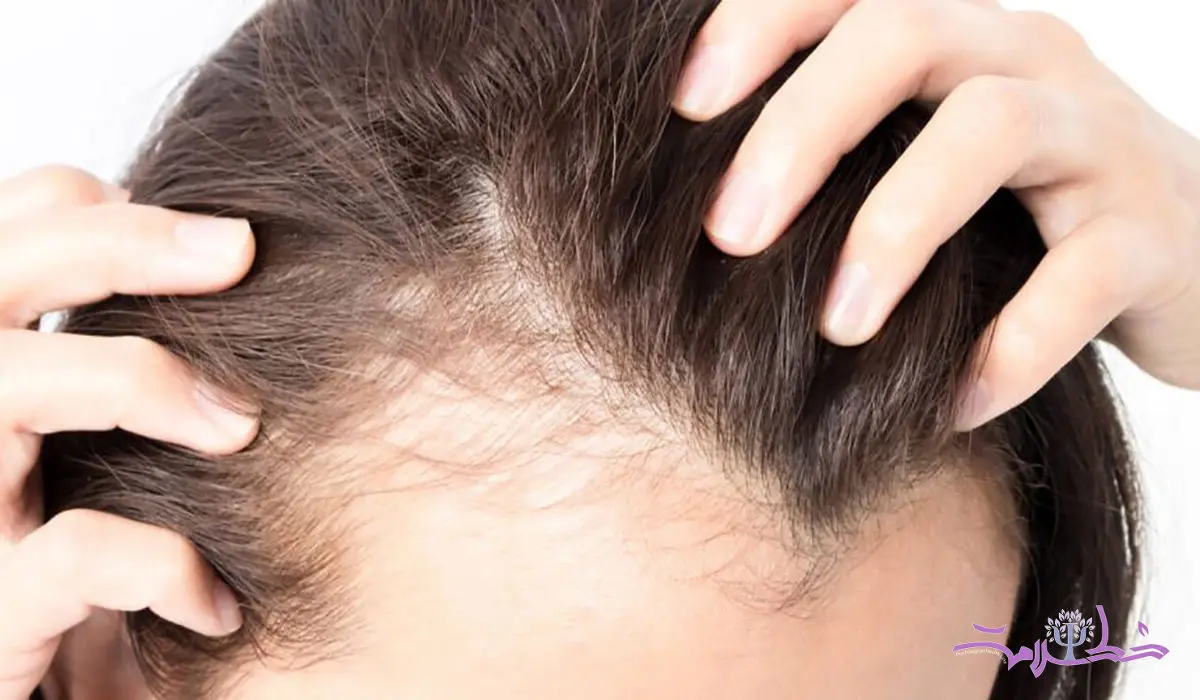 این قرص رایج ضد ریزش مو با افسردگی و خودکشی مرتبط است!