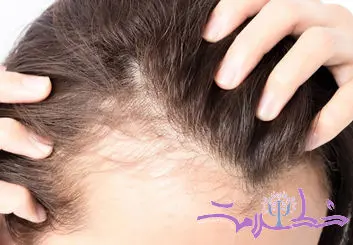 این قرص رایج ضد ریزش مو با افسردگی و خودکشی مرتبط است!