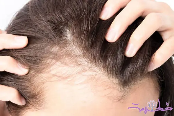 این قرص رایج ضد ریزش مو با افسردگی و خودکشی مرتبط است!