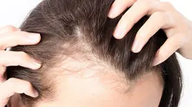 این قرص رایج ضد ریزش مو با افسردگی و خودکشی مرتبط است!