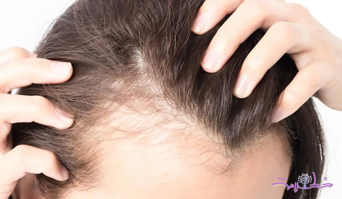 این قرص رایج ضد ریزش مو با افسردگی و خودکشی مرتبط است!