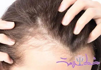 این قرص رایج ضد ریزش مو با افسردگی و خودکشی مرتبط است!