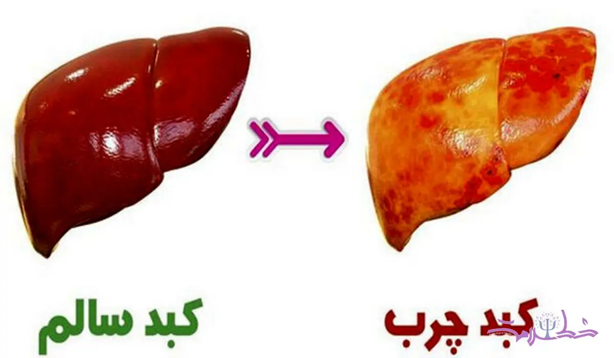 نشانه‌های چرب شدن کبد 
