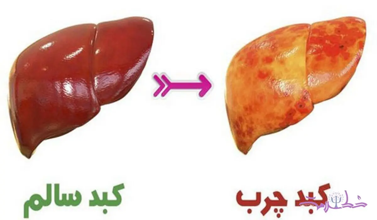 نشانه‌های چرب شدن کبد 