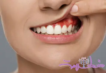 دندان آبسه چیست؟+ علائم و چگونه اتفاق می افتد؟