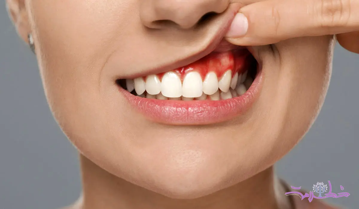 دندان آبسه چیست؟+ علائم و چگونه اتفاق می افتد؟