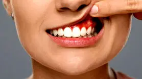 دندان آبسه چیست؟+ علائم و چگونه اتفاق می افتد؟