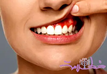 دندان آبسه چیست؟+ علائم و چگونه اتفاق می افتد؟