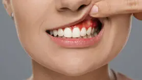 دندان آبسه چیست؟+ علائم و چگونه اتفاق می افتد؟