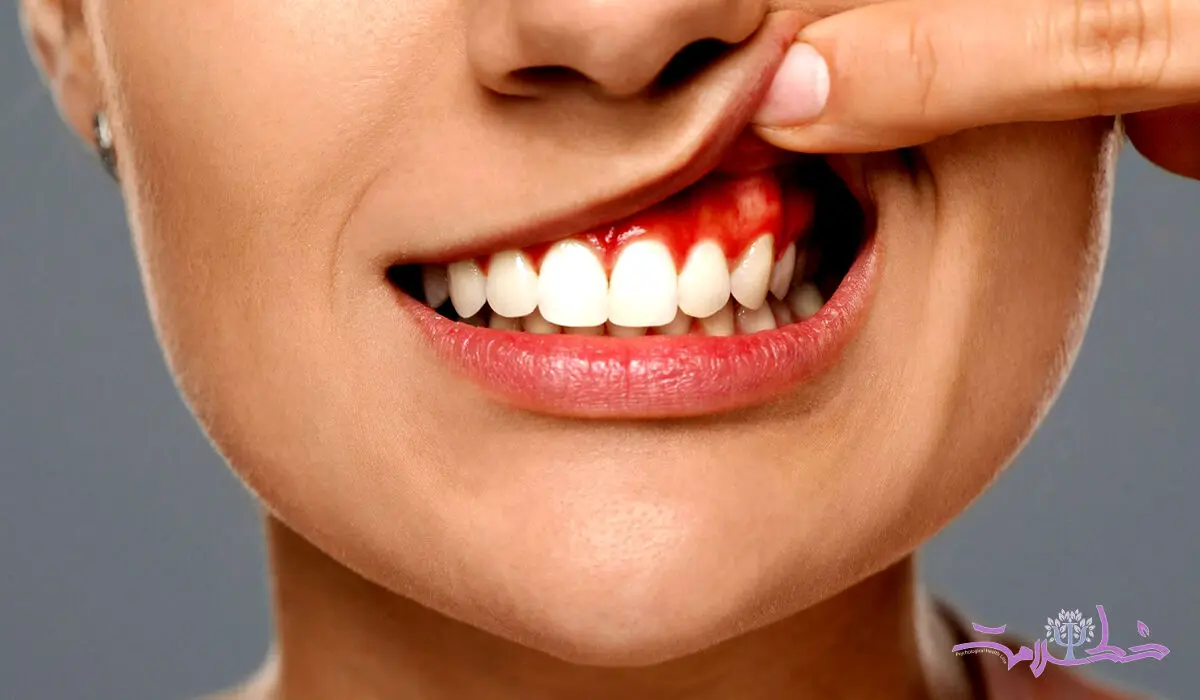 دندان آبسه چیست؟+ علائم و چگونه اتفاق می افتد؟