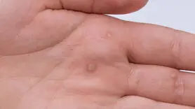 فیلم / از بین بردن زگیل به روش خانگی 
