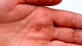 فیلم / از بین بردن زگیل به روش خانگی 
