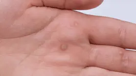 فیلم / از بین بردن زگیل به روش خانگی 
