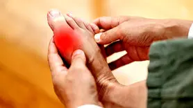 نقرس از چه سنی مردان را گرفتار می کند+علائم