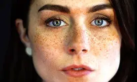 هیپوپیگمنتیشن چیست؟+ علل، علائم و روش‌های درمانی 