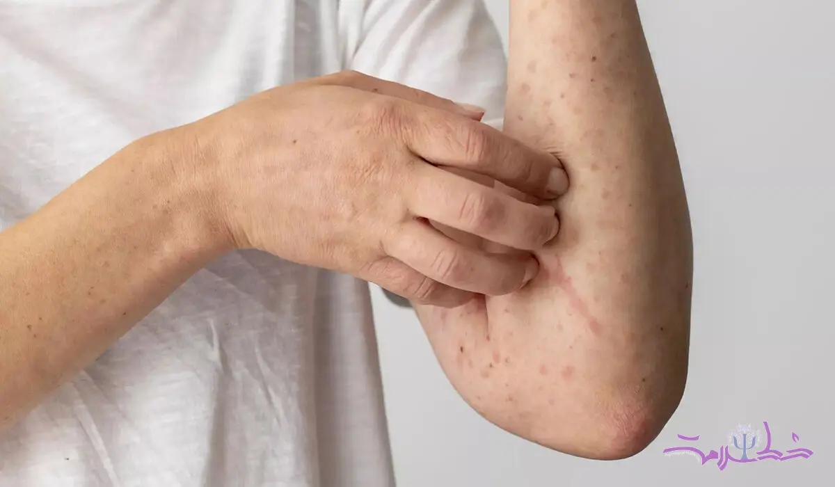 سندرم آلفا گال چیست؟+چه کسی در معرض خطر آلفا گال است؟