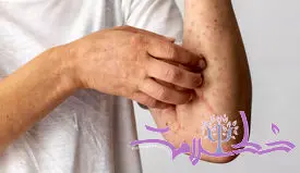 سندرم آلفا گال چیست؟+چه کسی در معرض خطر آلفا گال است؟