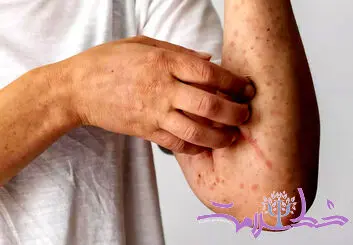 سندرم آلفا گال چیست؟+چه کسی در معرض خطر آلفا گال است؟