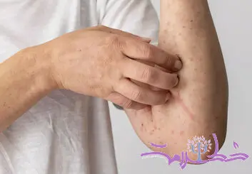 سندرم آلفا گال چیست؟+چه کسی در معرض خطر آلفا گال است؟