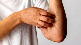 سندرم آلفا گال چیست؟+چه کسی در معرض خطر آلفا گال است؟