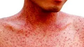 سرخک عامل مرگ های تلخ و فوری + علائم و درمان