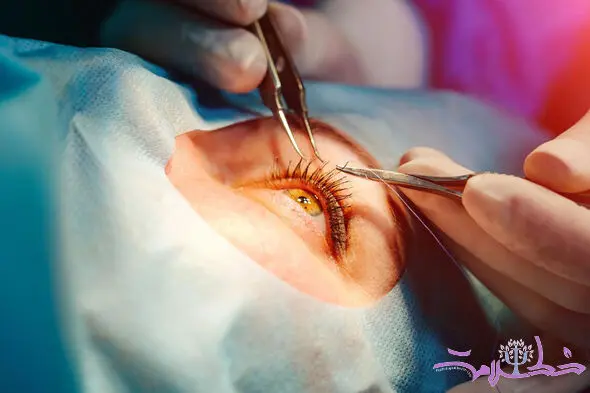 جراحی آب مروارید؛ چه زمانی لازم است، چگونه انجام می‌شود و کدام لنز برای شما مناسب است؟