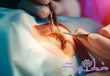 جراحی آب مروارید؛ چه زمانی لازم است، چگونه انجام می‌شود و کدام لنز برای شما مناسب است؟