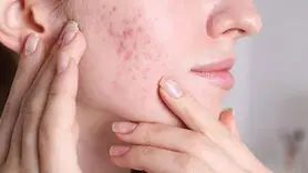 محصولات محبوب ضد آکنه و خطر ابتلا به سرطان
