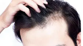 ریزش مو با مشکلات معده رابطه دارد  + فیلم