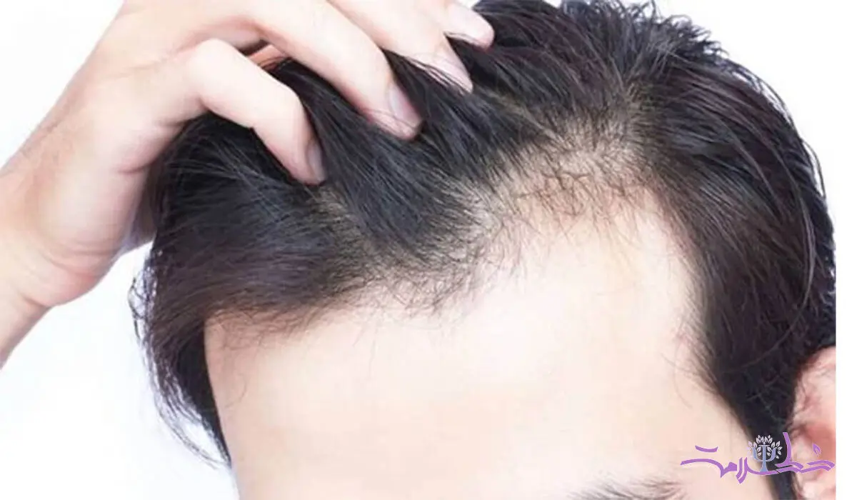 ریزش مو با مشکلات معده رابطه دارد  + فیلم