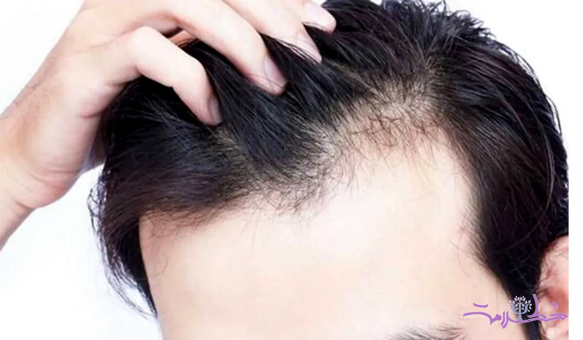 ریزش مو با مشکلات معده رابطه دارد  + فیلم