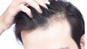 ریزش مو با مشکلات معده رابطه دارد  + فیلم