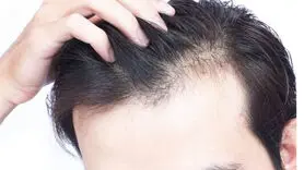 ریزش مو با مشکلات معده رابطه دارد  + فیلم
