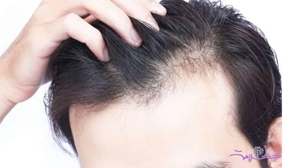 ریزش مو با مشکلات معده رابطه دارد  + فیلم