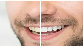 بهترین روش‌ سفید کردن دندان در منزل یا مطب دندانپزشکی