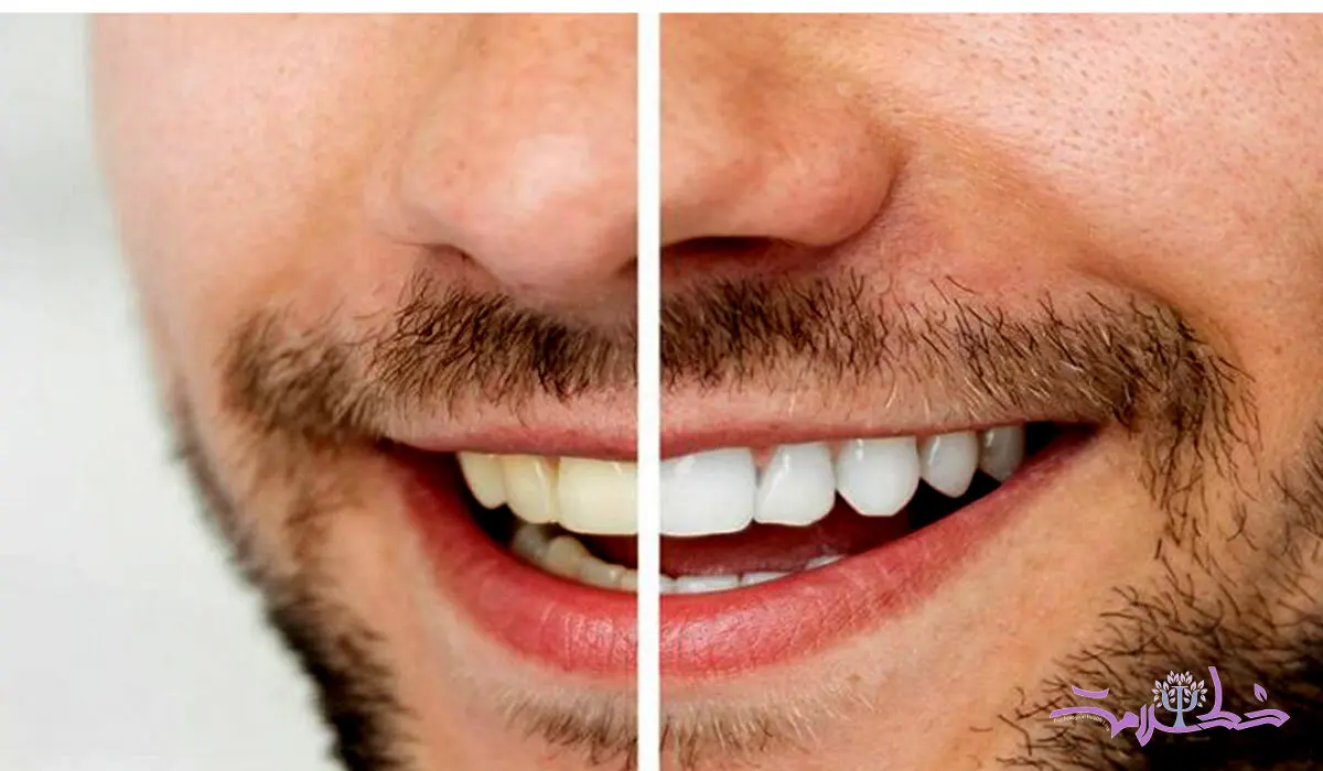 بهترین روش‌ سفید کردن دندان در منزل یا مطب دندانپزشکی