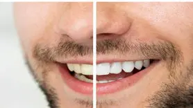 بهترین روش‌ سفید کردن دندان در منزل یا مطب دندانپزشکی