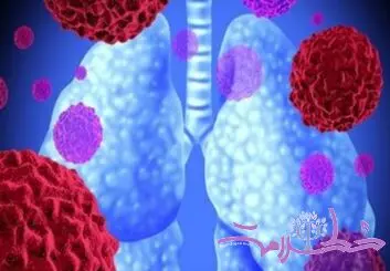 داروی دیابت که شاید به سلاحی علیه سرطان ریه تبدیل شود