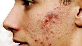 از شر این جوش های سمج طبیعی خلاص شوید