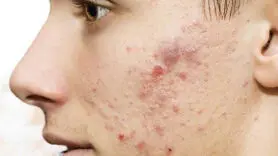 از شر این جوش های سمج طبیعی خلاص شوید