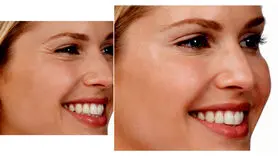 بجای بوتاکس از این 15 روش طب سنتی استفاده کنید