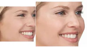بجای بوتاکس از این 15 روش طب سنتی استفاده کنید