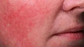 تاثیرات مخرب هوای شرجی بر زیبایی